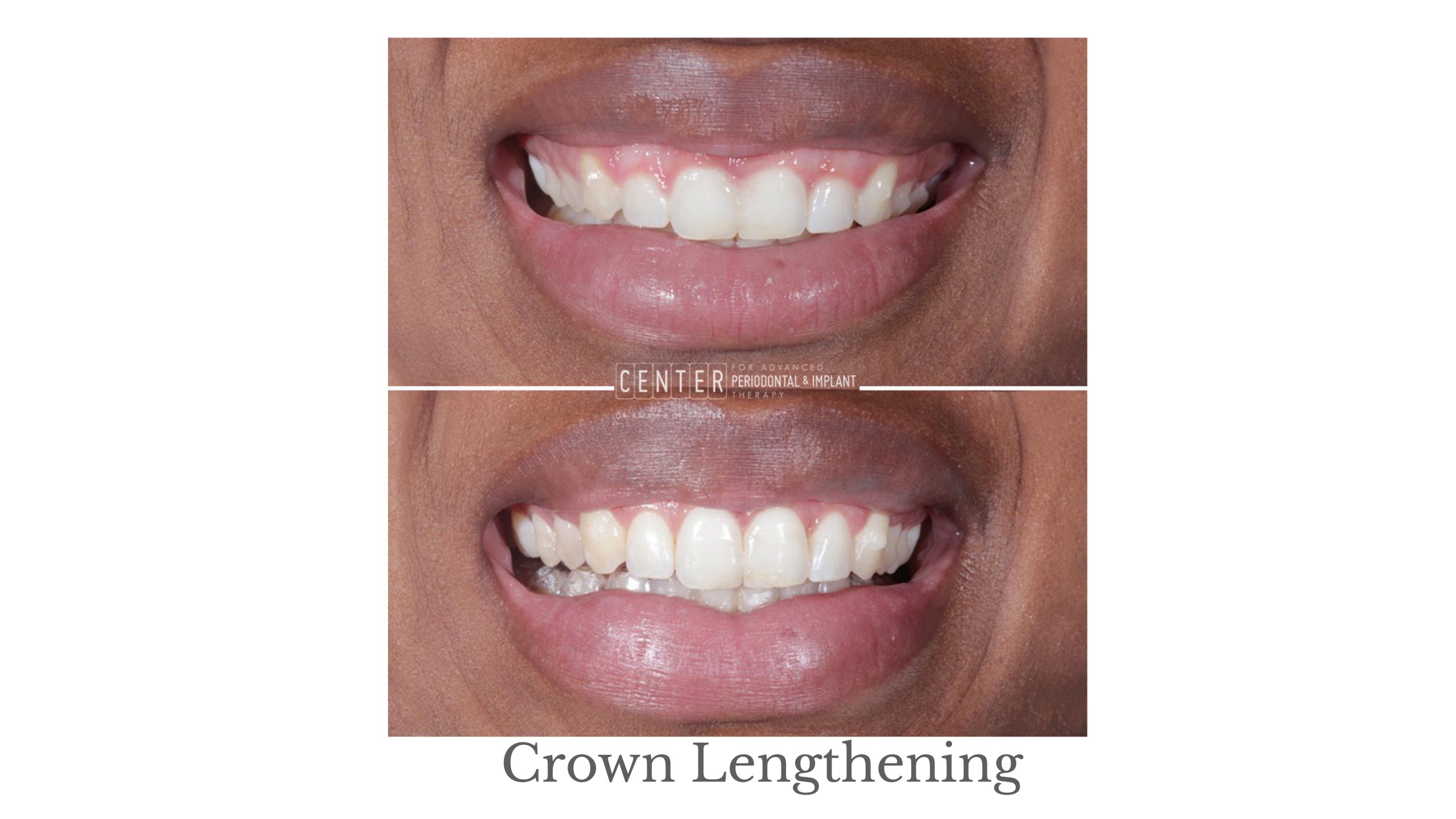 Dental implants in Gardena, CA