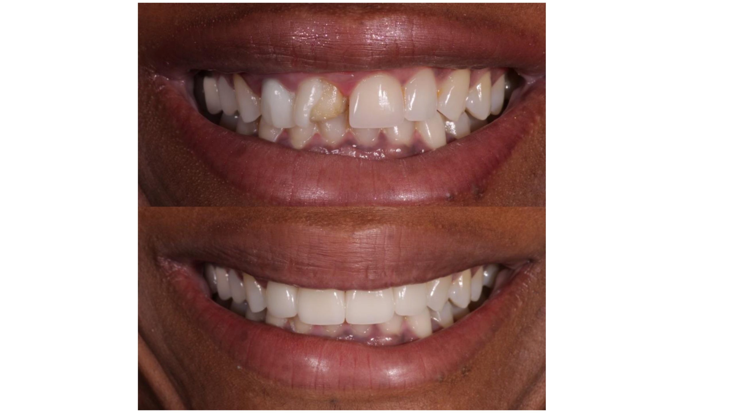 Dental implants in Gardena, CA