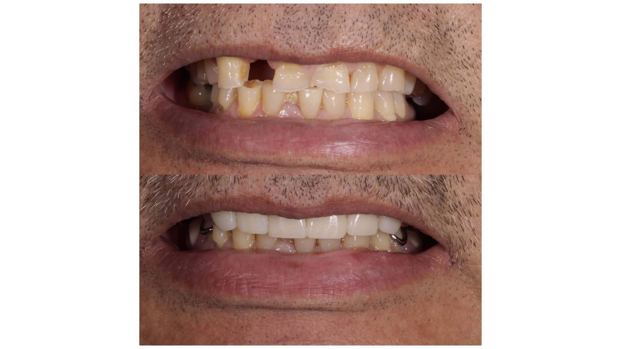 Dental implants in Gardena, CA