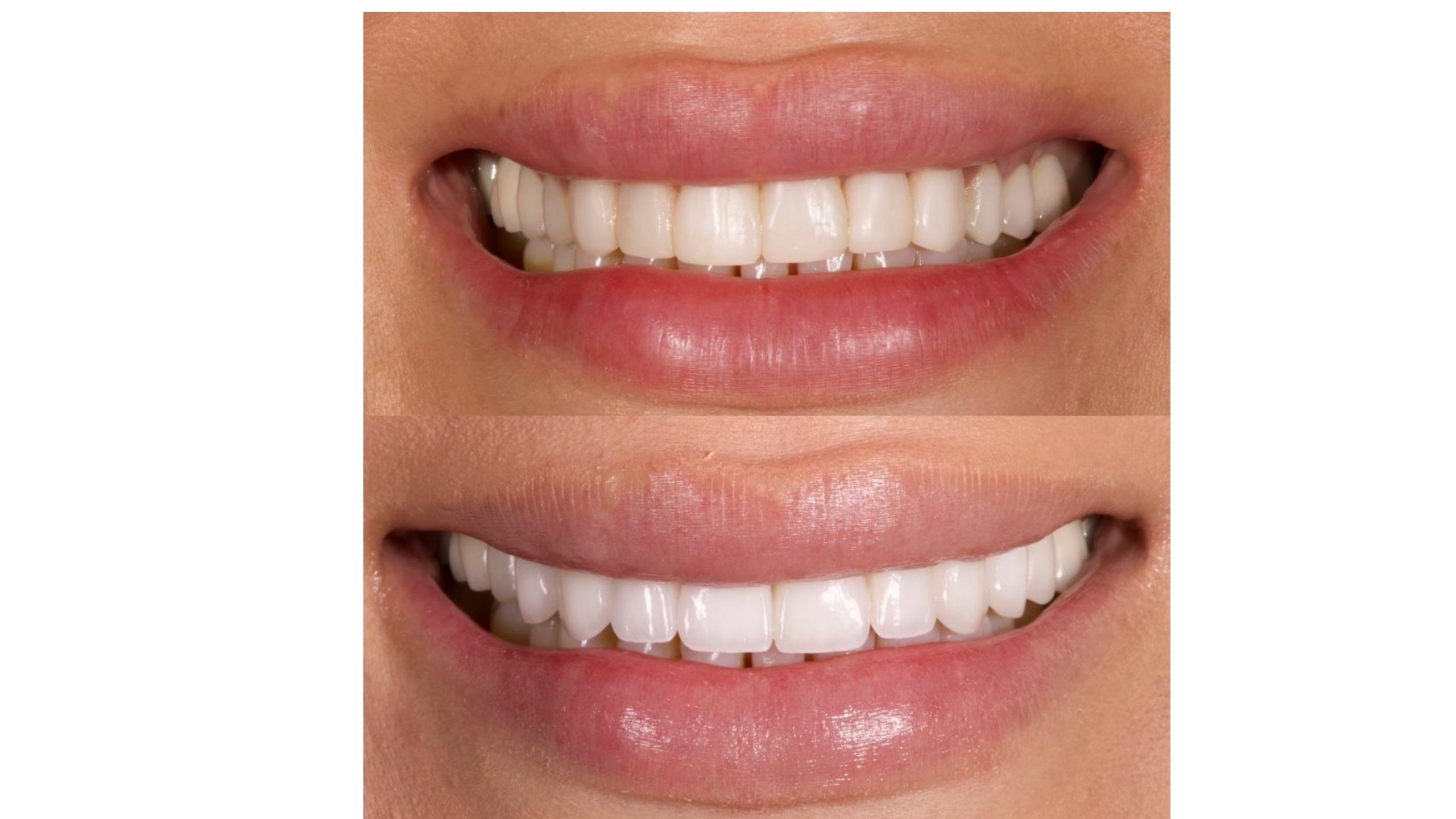 Dental implants in Gardena, CA