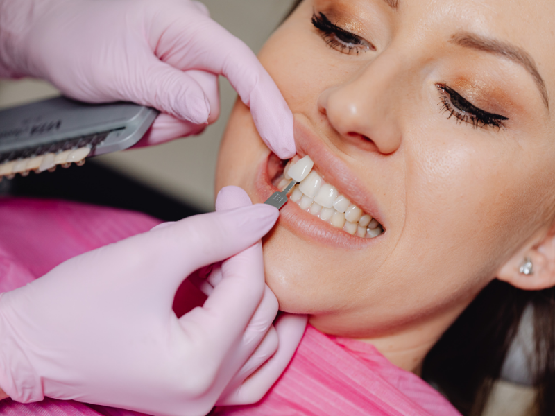 Cosmetic Dentistry - Color Matching Veneers - Plaza Dental Specialty Group