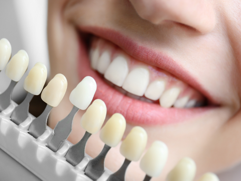 Cosmetic Dentistry - Picking Out Color for Dental Veneers - Plaza Dental Specialty Group