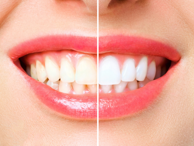 Cosmetic Dentistry - Teeth Whitening Before and After - Plaza Dental Specialty Group