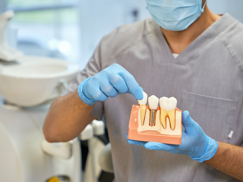 Dental Implant - Model of Implant - Plaza Dental Specialty Group