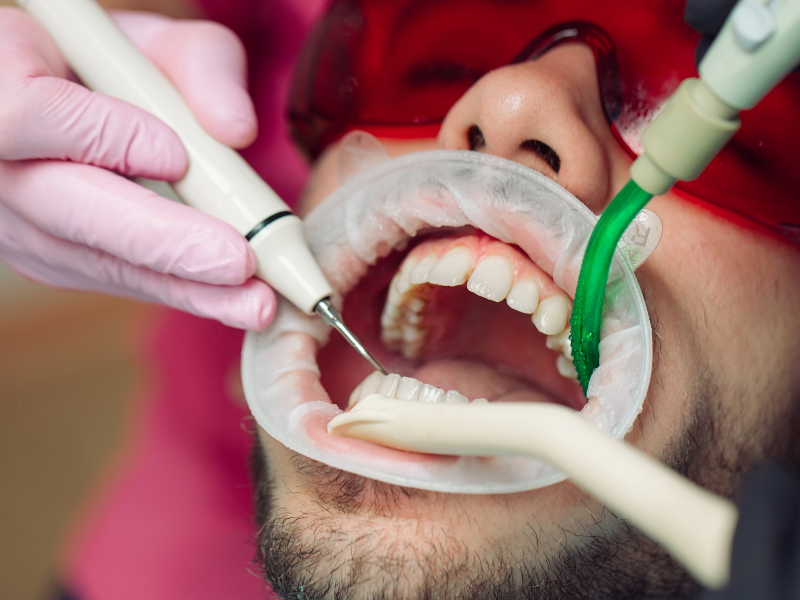 Periodontal Treatment - Dental Scaling Done On Patient - Plaza Dental Specialty Group