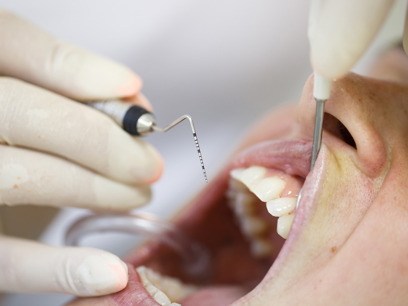 Periodontal Treatment - Patint About to Start Dental Scaling Service - Plaza Dental Specialty Group