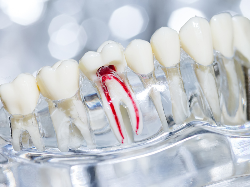 Root Canal Therapy - Model of Root Canal - Plaza Dental Specialty Group