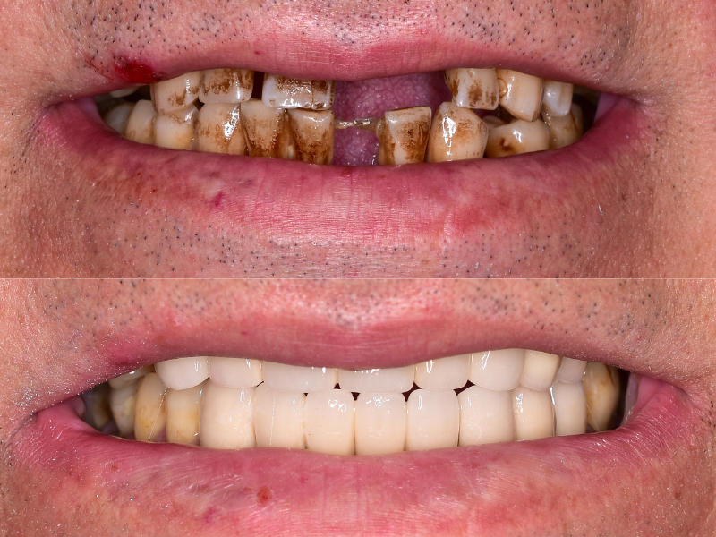 before and after implants los angeles