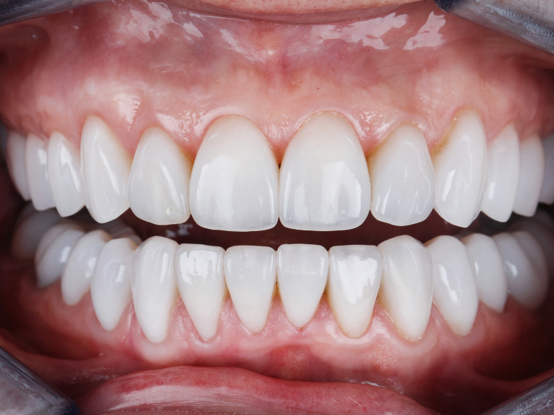 plaza dental gardena implants
